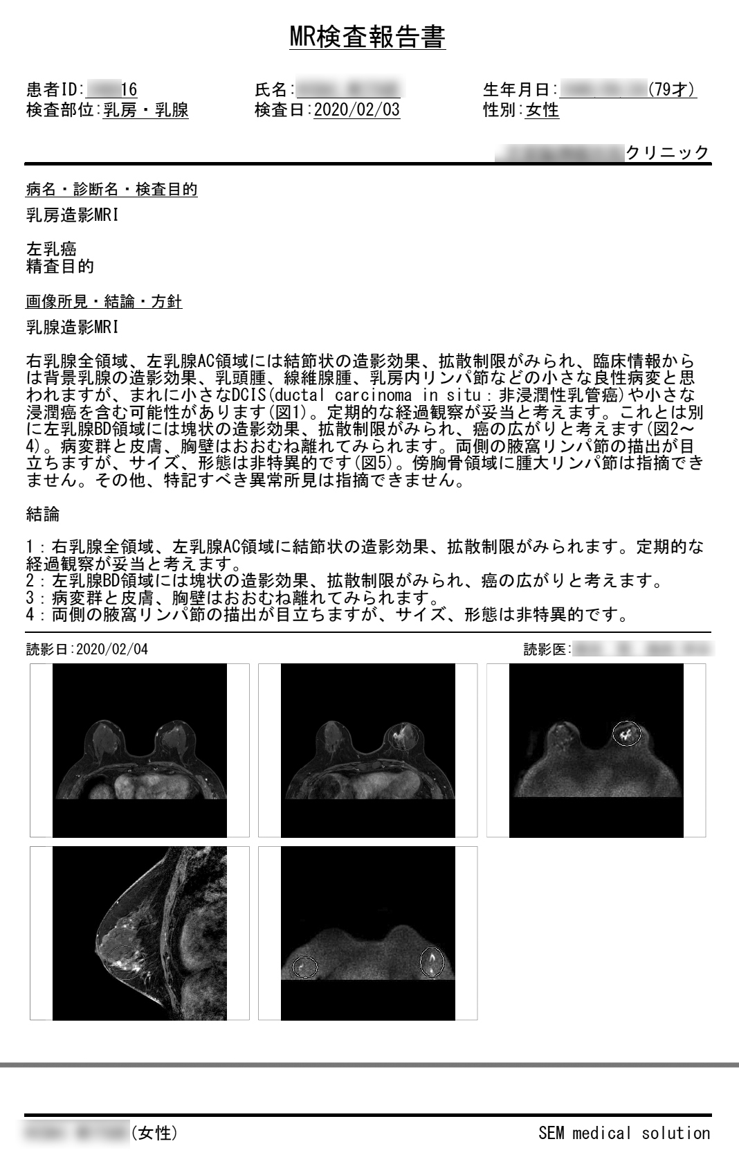 遠隔画像診断のpdfレポート画面乳腺MRI